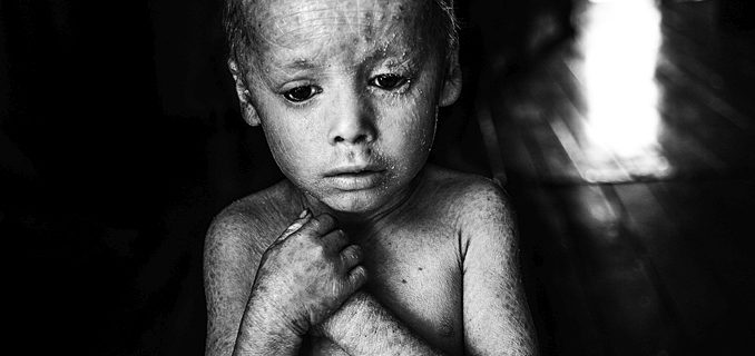 Kind mit Folgen von Pestiziden